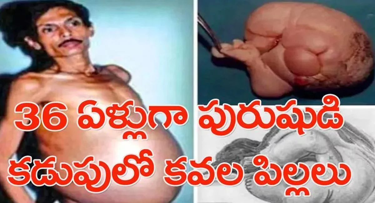 Viral News : ఏకంగా కవల పిల్లలకు జన్మనిచ్చిన పురుషుడు… ఇలాంటి ఘటన నెవర్ బిఫోర్ ఎవర్ ఆఫ్టర్…