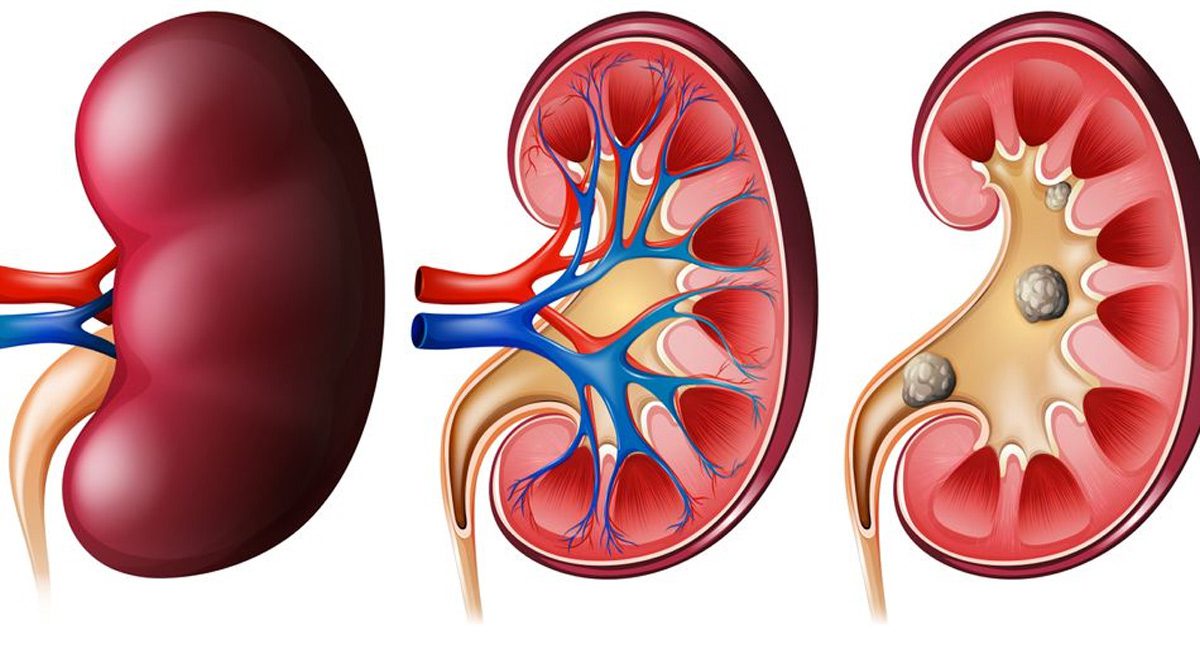 Health tips : కిడ్నీలో రాళ్లకు చెక్ పెట్టే ఐదు పదార్థాలు ఇవే….